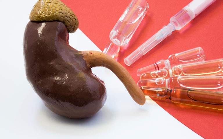 kidney transplant