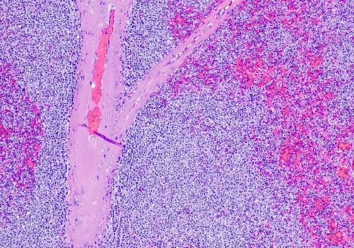 Higher liver stiffness persists several months after COVID-19 infection|Glofitamab fast and effective in refractory mantle cell lymphoma