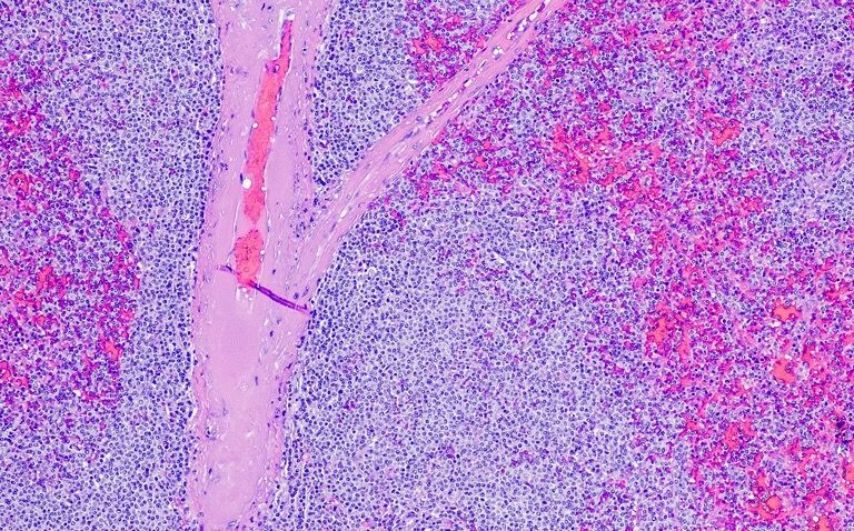 Higher liver stiffness persists several months after COVID-19 infection|Glofitamab fast and effective in refractory mantle cell lymphoma