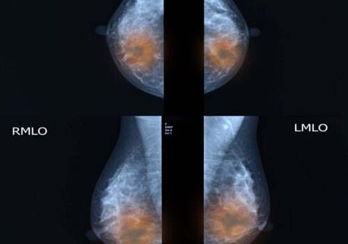 Breast MRI
