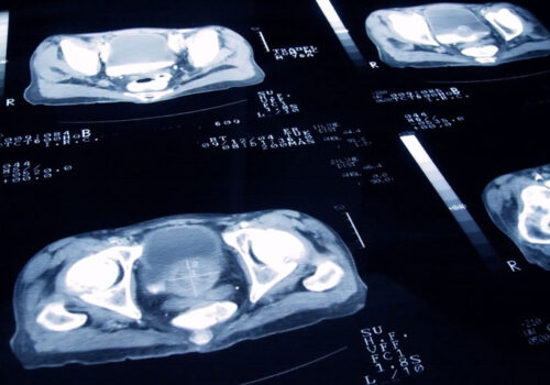 prostate cancer slides