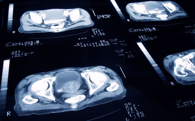 prostate cancer slides