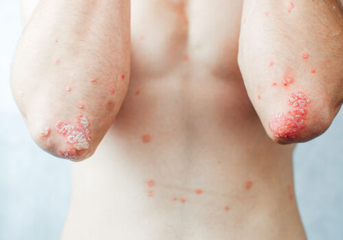 cosentyx psoriasis