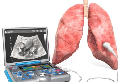 Lung ultrasound scan non-inferior to chest X-ray for COVID-19 pneumonia diagnosis