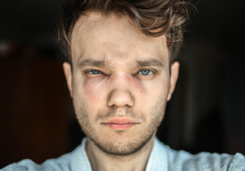 angioedema