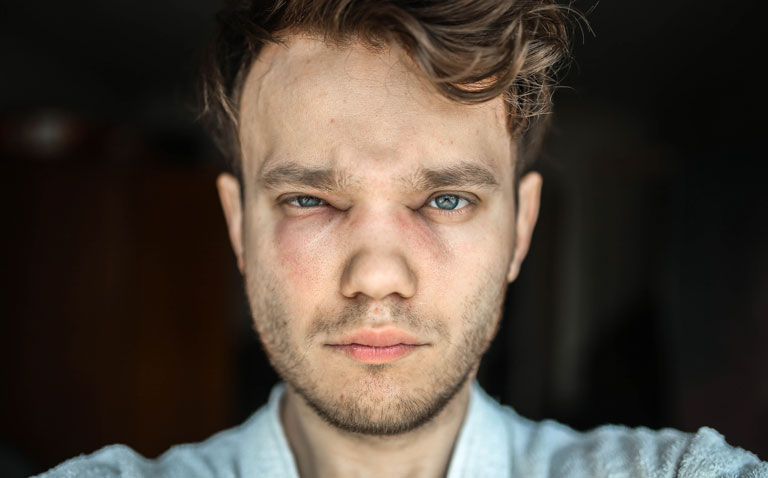 angioedema