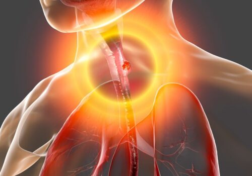 Rise on cases of oesophageal cancer in under 30s