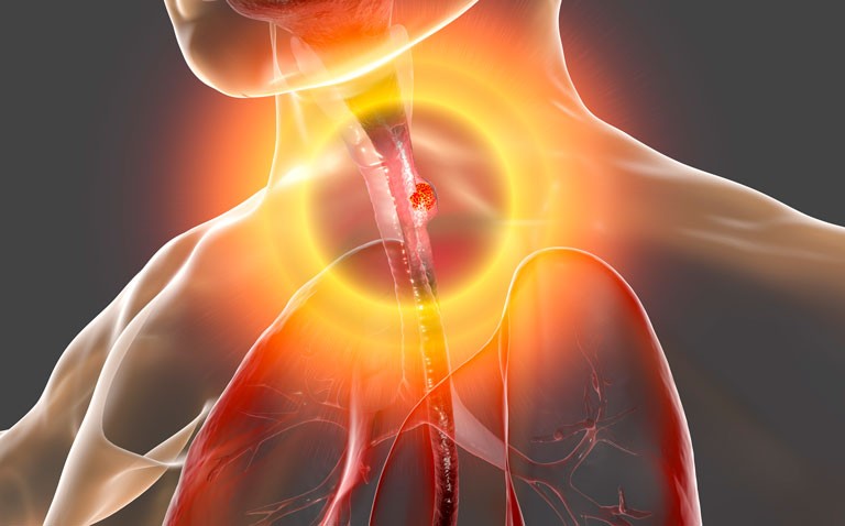Rise on cases of oesophageal cancer in under 30s