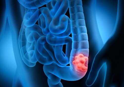 Risk of early-onset colorectal cancer reduced by higher intake of vitamin D