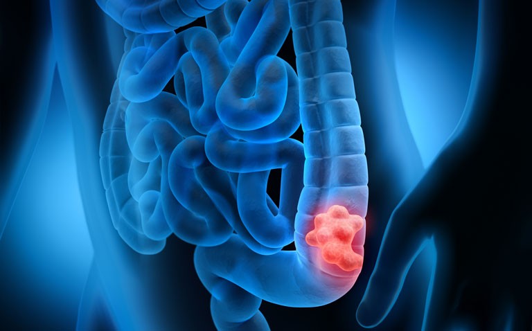 Risk of early-onset colorectal cancer reduced by higher intake of vitamin D