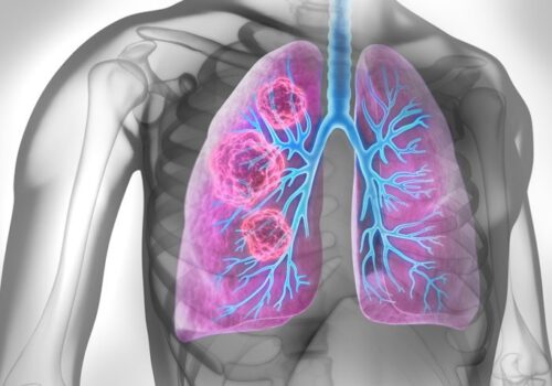 tepotinib lung cancer