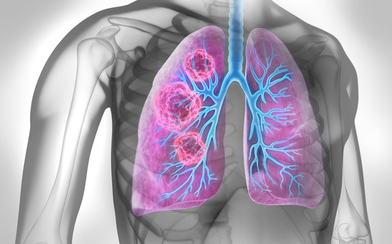 tepotinib lung cancer