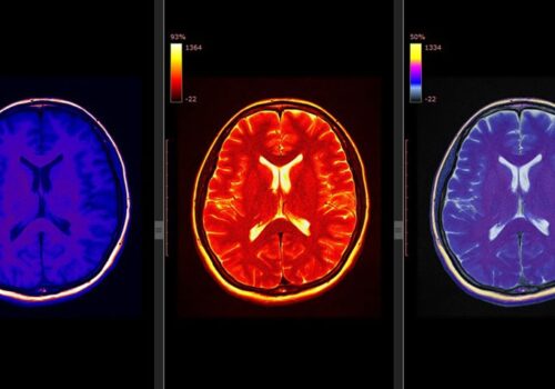 cannabis use and neurodevelopment