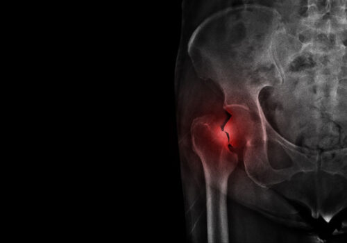 bisphosphonate therapy