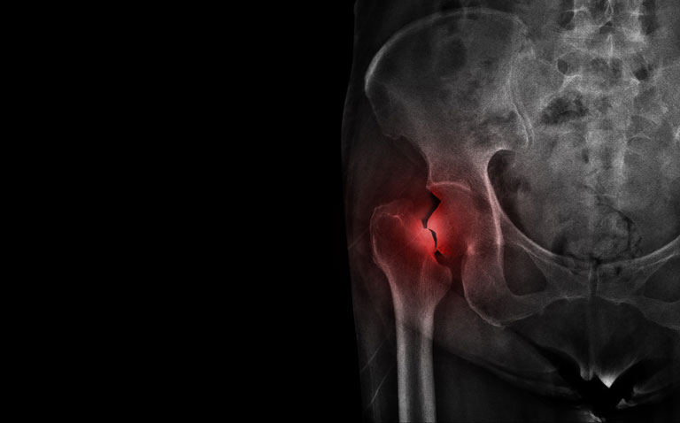 bisphosphonate therapy