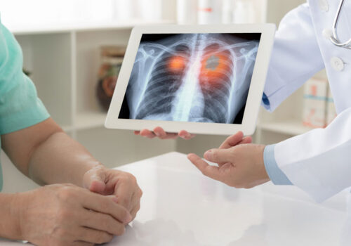 non-small cell lung cancer