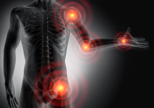 Beta-blockers associated with analgesic effect in osteoarthritis