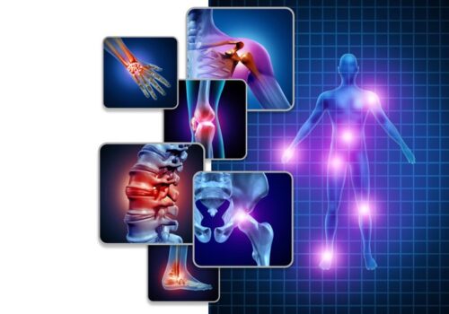Risankizumab receives MHRA approval for psoriatic arthritis