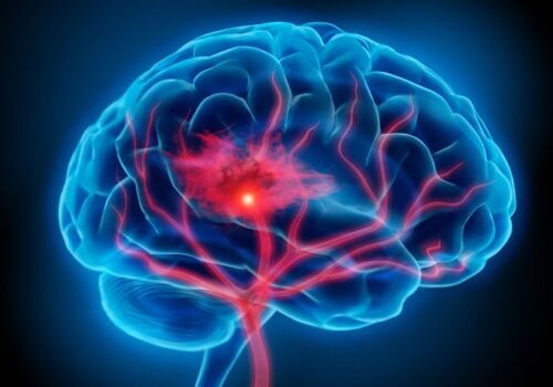 Ischaemic stroke