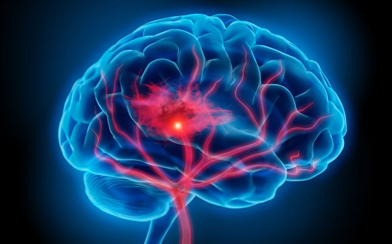 Ischaemic stroke