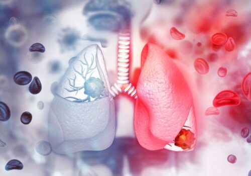 lung cancer