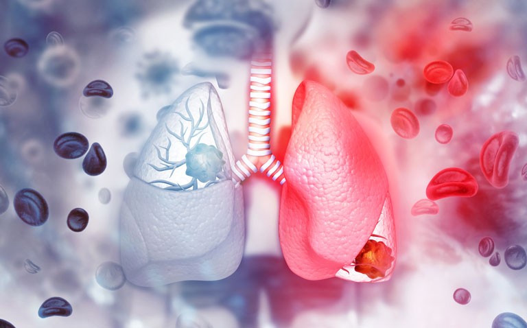lung cancer