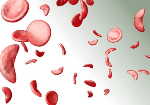 sickle cell disease