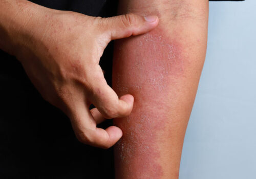 Ruxolitinib cream significantly improves patient outcomes in atopic dermatitis