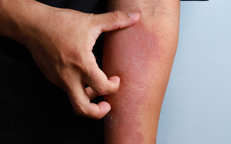Ruxolitinib cream significantly improves patient outcomes in atopic dermatitis