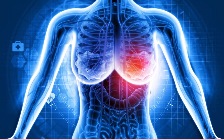 breast cancer