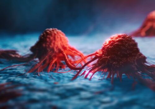 Thiazide diuretics and increased risk of skin cancer