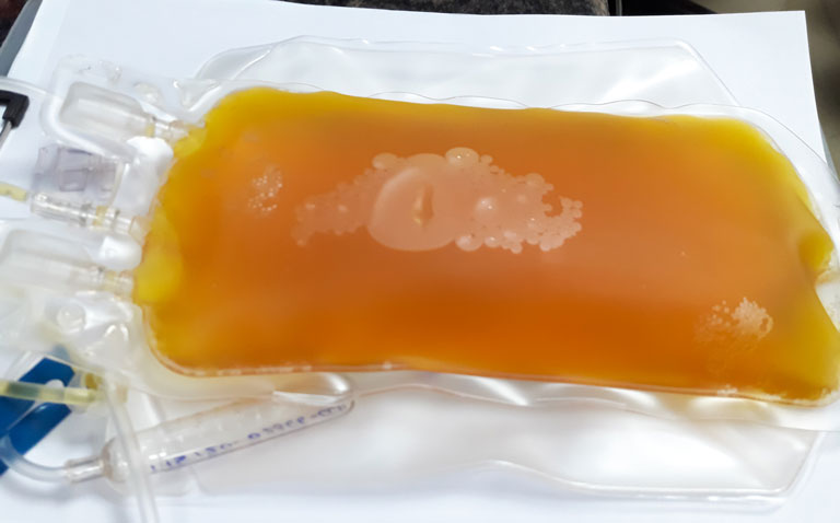 convalescent plasma