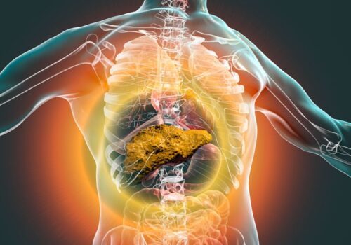 cirrhosis in covid