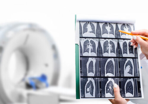 Lung CT scan