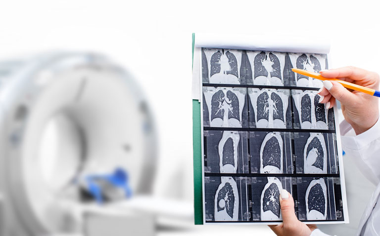 Lung CT scan