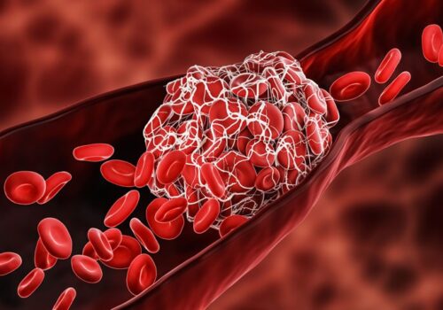 thrombosis and covid