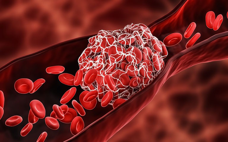 thrombosis and covid