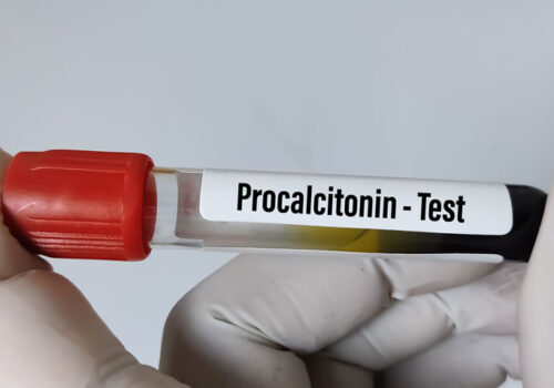 Procalcitonin levels predictive of severe disease in Covid-19