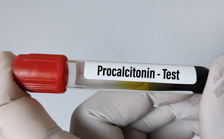 Procalcitonin levels predictive of severe disease in Covid-19