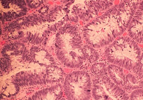 Colorectal cancer diagnoses and pandemic