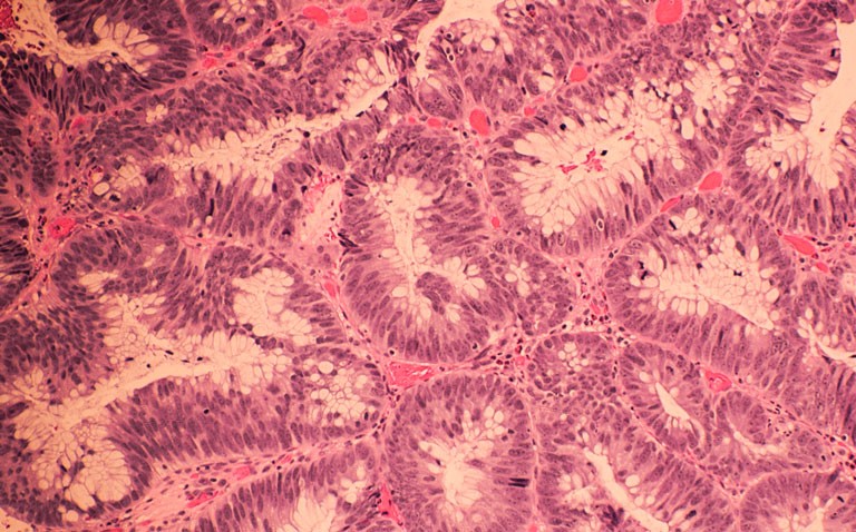 Colorectal cancer diagnoses and pandemic