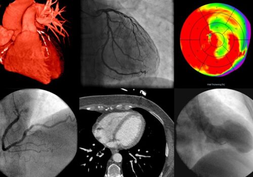 echocardiography covid