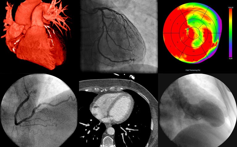 echocardiography covid