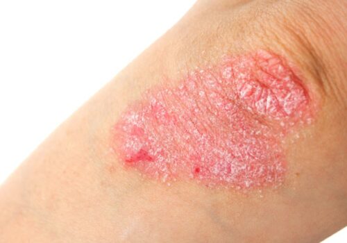 bimekizumab psoriasis