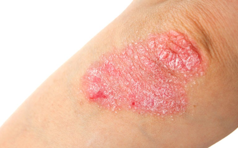 bimekizumab psoriasis