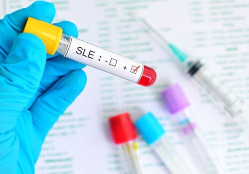 systemic lupus erythematosus