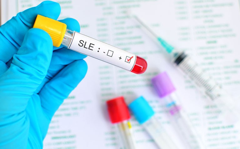 systemic lupus erythematosus