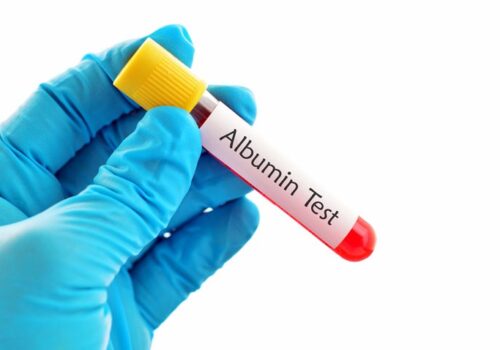 Serum albumin independent risk factor for severe infection and mortality in Covid-19