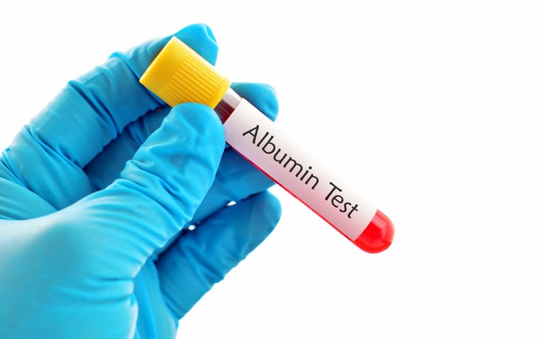 Serum albumin independent risk factor for severe infection and mortality in Covid-19
