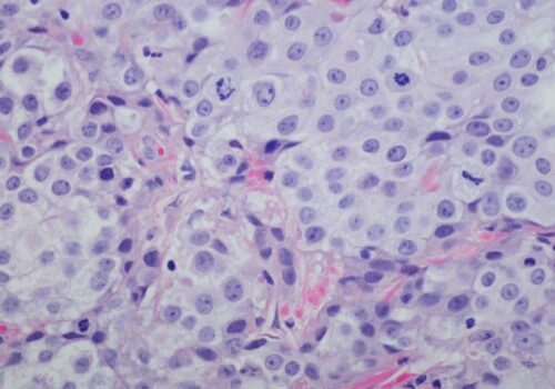 keratin 17 as a potential biomarker in bladder cancer